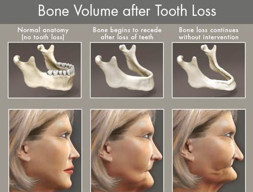 Illustration comparing adequate bone volume to bone loss at an implant site
